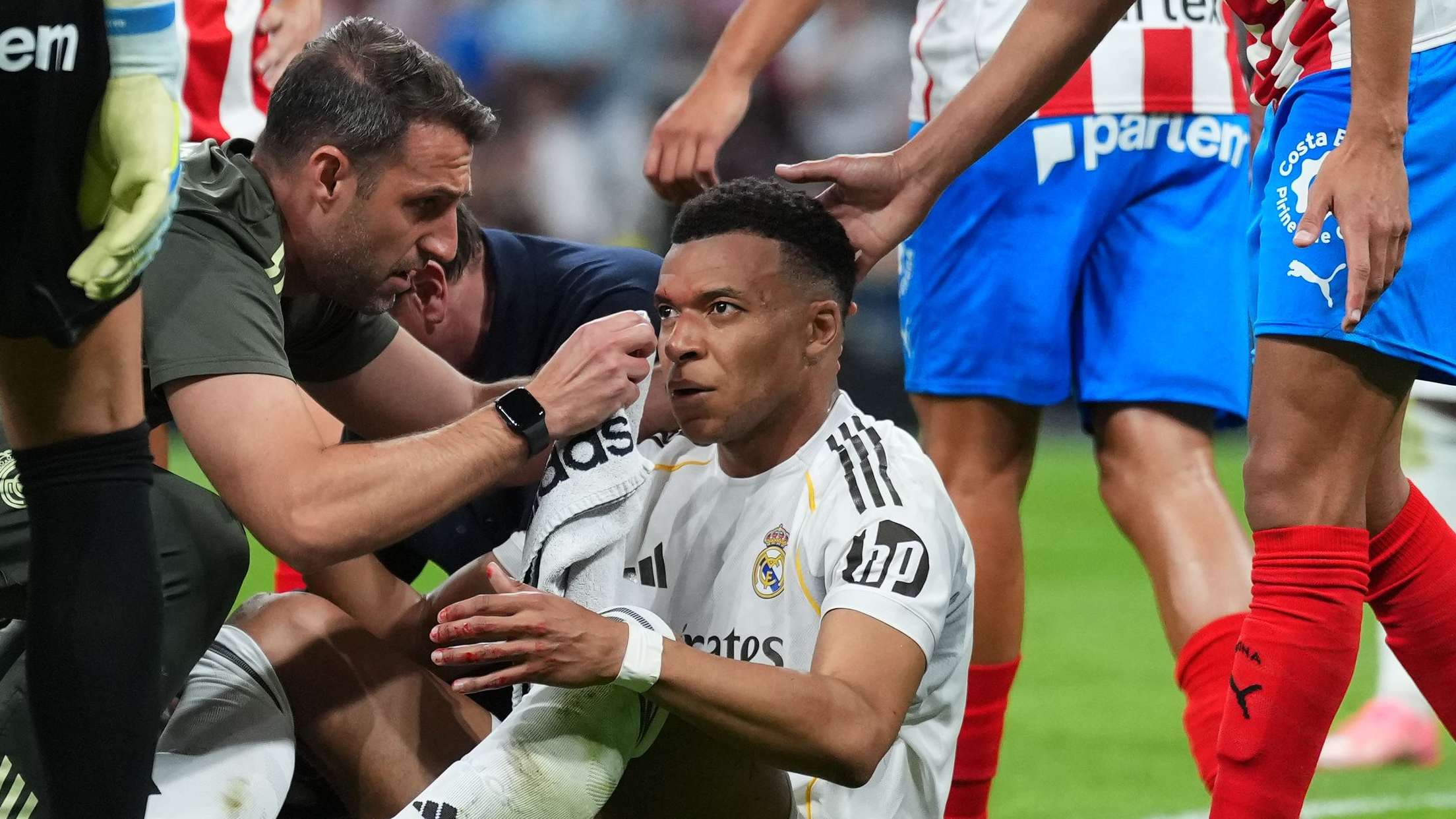 เอ็มบัปเป้เผยรอยแผลบนใบหน้า หลัง เรอัล มาดริด เสมอกีโรนา 1-1 ในลา ลีกา